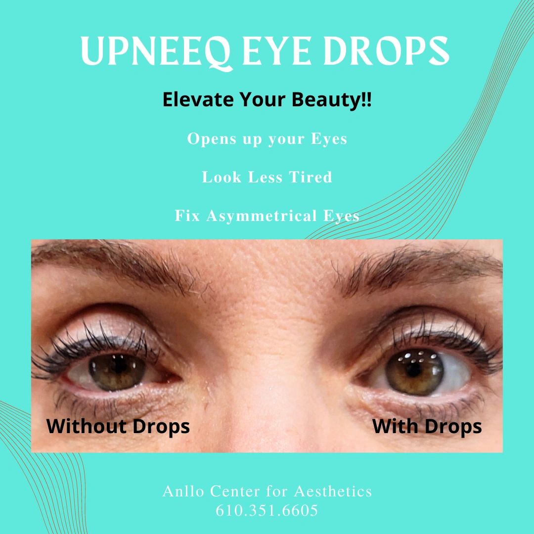 Do you have LowLying Eyelids? Upneeq Can Fix That!!